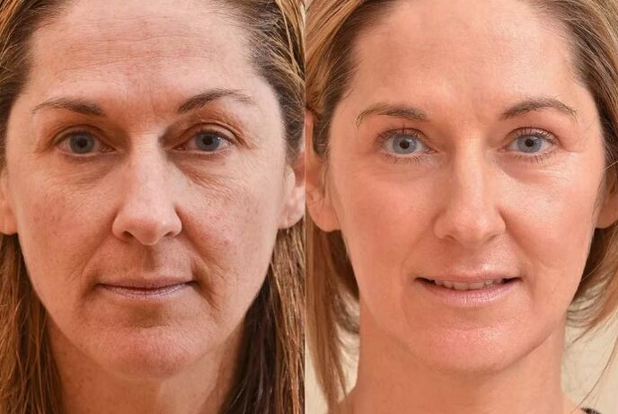Rejuvenate the face before and after