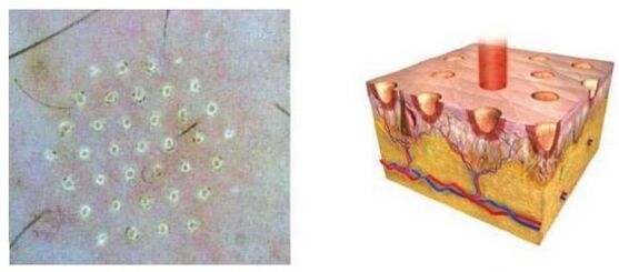 Digital fraction laser affects the skin spot