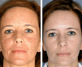 Effect of procedure