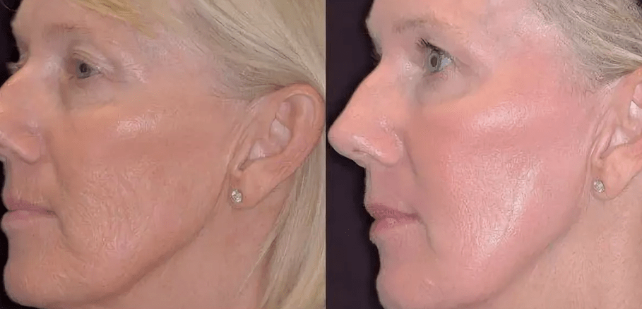 Laser PhaseTothothysis before and after