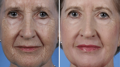 Before and after images of partial facial rejuvenation