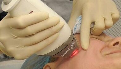 How is partial skin rejuvenation performed