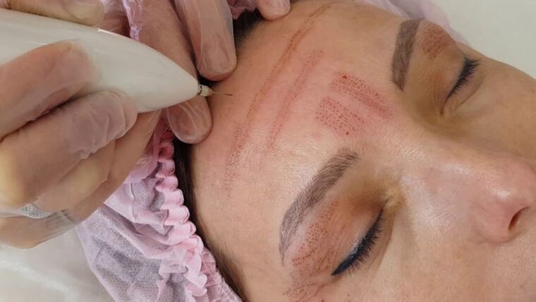 Facial skin rejuvenation with plasma