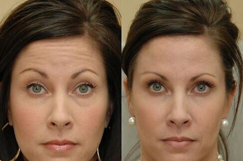 Botulinum toxin injections are suitable for use in all areas of the face