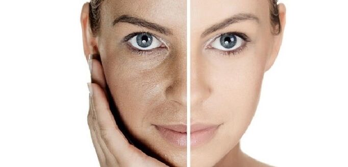 Before and after facial rejuvenation