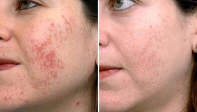 Before and after images of micro-skin rejuvenation