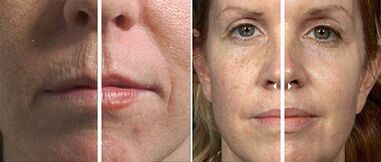 Before and after partial skin rejuvenation