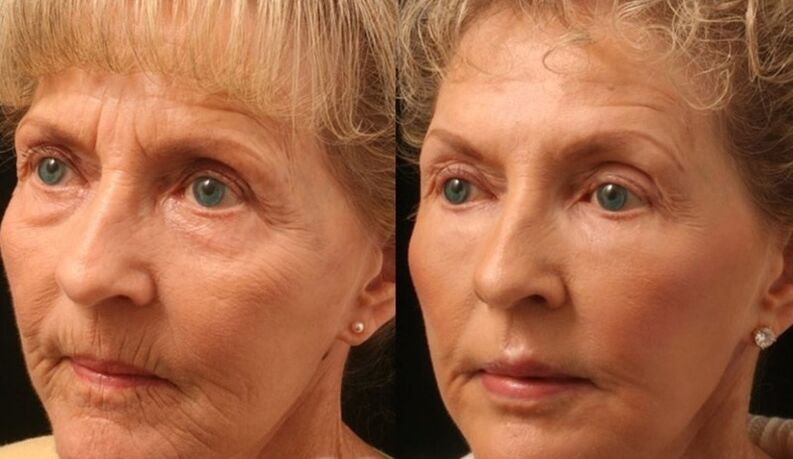 before and after pictures of fractional laser rejuvenation