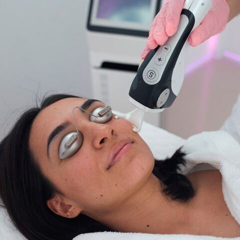 Fractional laser facial treatment
