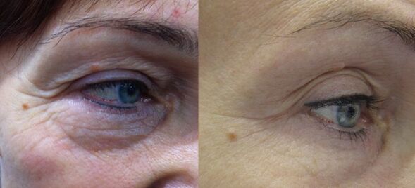 Effective results of rejuvenation of the area around the eyes with plasma
