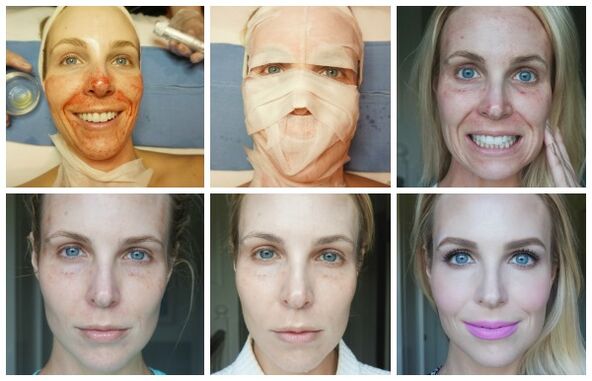 Facial skin healing stages after successful plasma lift