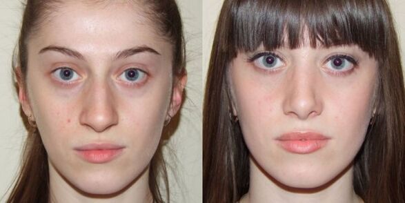 Girl before and after facial rejuvenation with plasma