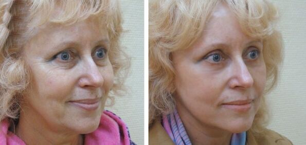 Woman before and after facial rejuvenation with plasma